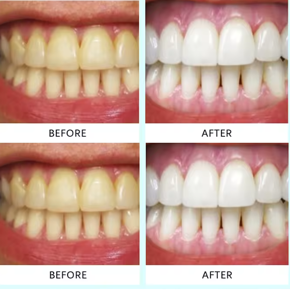 Bandes de Blanchiment Dentaire Lumineux - 7 Traitements pour un Sourire Éclatant