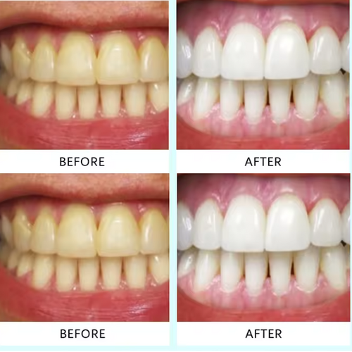 Bandes de Blanchiment Dentaire Lumineux - 7 Traitements pour un Sourire Éclatant