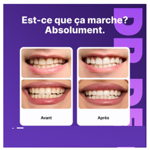 Bandes de Blanchiment Dentaire Lumineux - 7 Traitements pour un Sourire Éclatant
