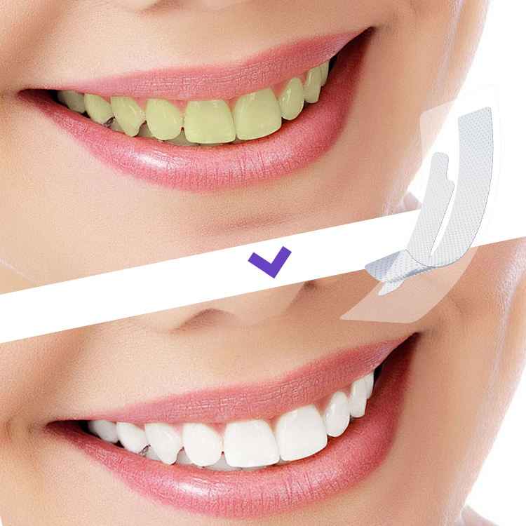 Bandes de Blanchiment Dentaire Lumineux - 7 Traitements pour un Sourire Éclatant